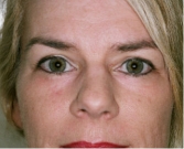 Feel Beautiful - Eyelid Surgery San Diego Case 40 - After Photo